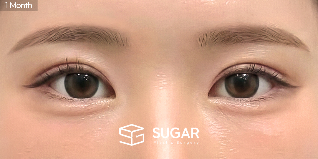 SUGAR美容外科 初) 自然癒着 + 目つき矯正 + 目頭切開 症例写真 - 施術後
