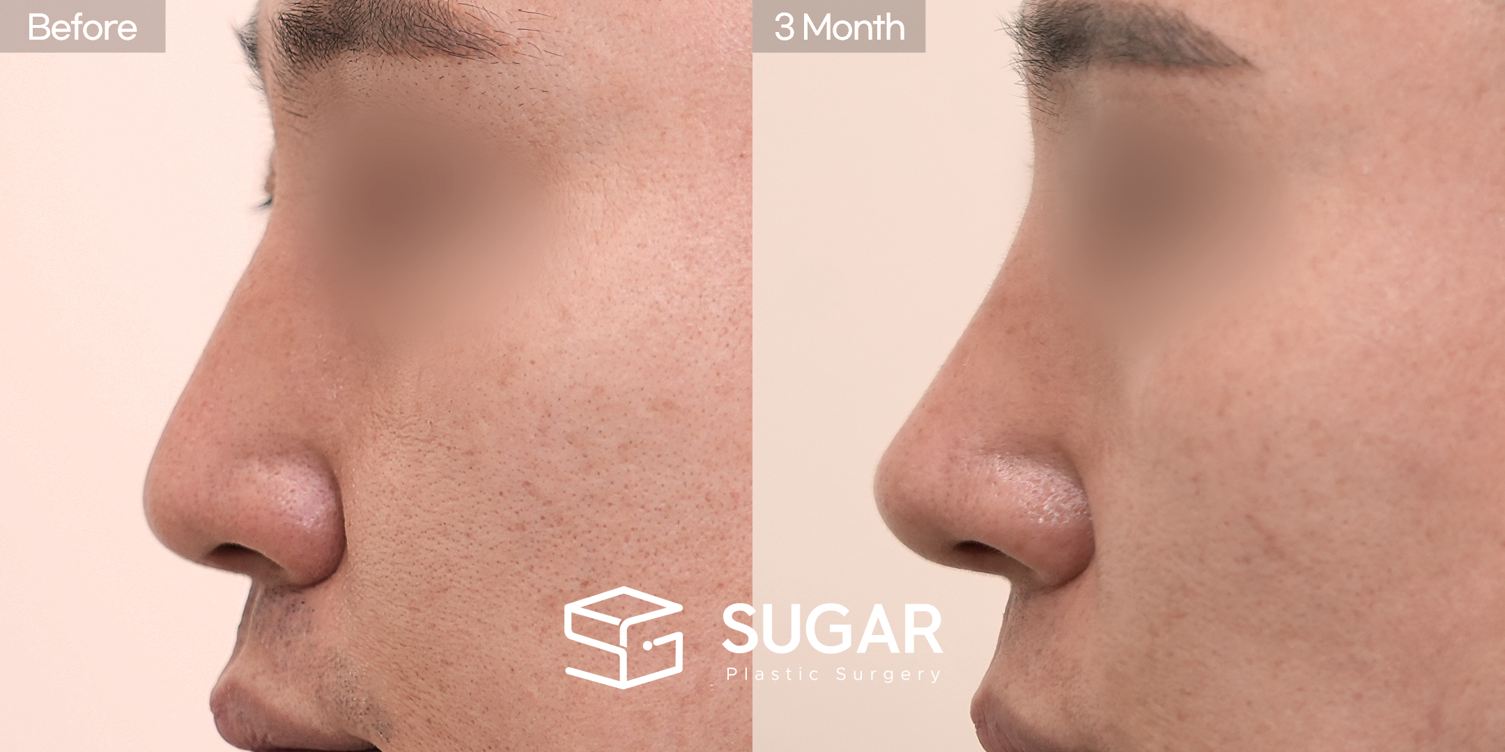 SUGAR美容外科 初) 鼻筋 無プロテーゼ+ 骨切り幅寄せ+ハンプ削り+鼻尖形成+鼻中隔延長(鼻中隔軟骨+耳介軟骨）+ 団子鼻矯正 症例写真 - 側面の施術前後比較