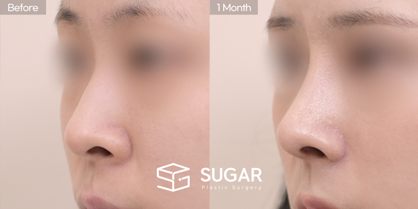 SUGAR美容外科 初) 鼻筋プロテーゼ + 寄贈肋軟骨 + 鼻中隔軟骨 + 鷲鼻矯正 + 鼻孔下げ + 小鼻縮小 症例写真 - 45度の施術前後比較