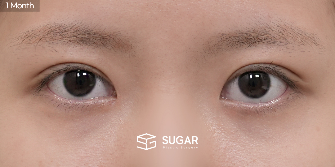SUGAR美容外科 初) 非切開眼瞼下垂矯正 + 目頭切開 症例写真 - 施術後