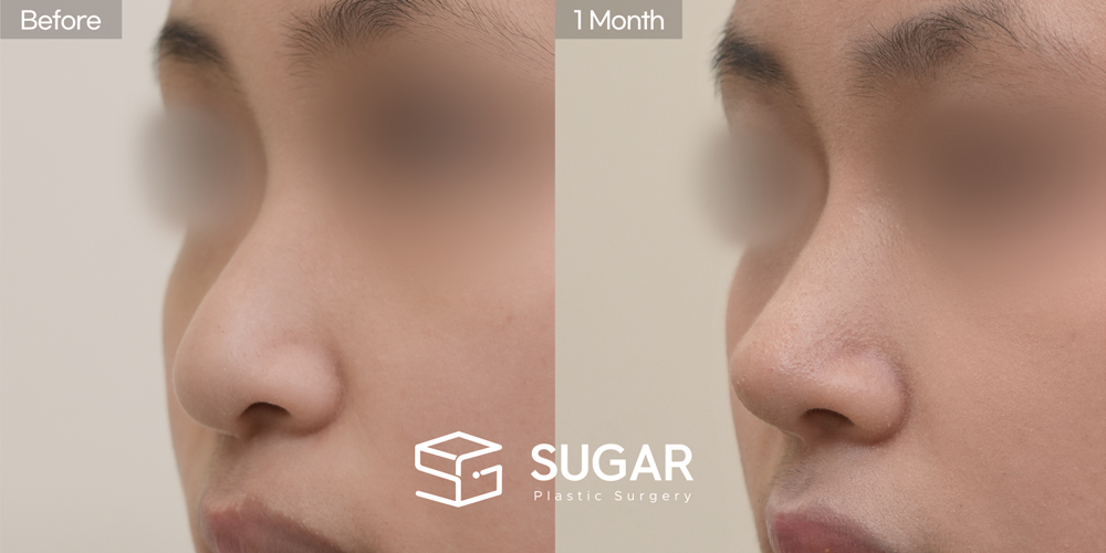 SUGAR美容外科 初) 鼻背（隆鼻） + 耳後筋膜 + 鼻尖形成 + 鼻中隔 + 耳介軟骨移植 + 団子鼻修正 + 長鼻短縮 症例写真 - 45度の施術前後比較