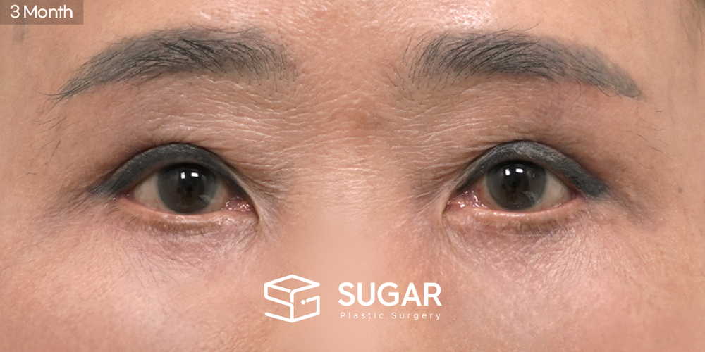 SUGAR美容外科 再) 眉下切開（眉下リフト） + 下眼瞼形成術 症例写真 - 施術後