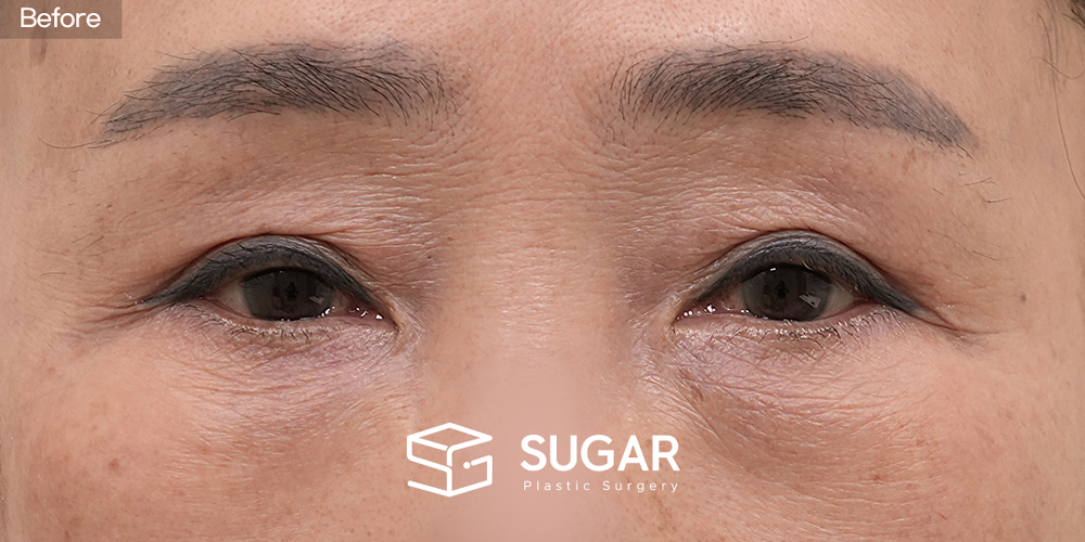 SUGAR美容外科 再) 眉下切開（眉下リフト） + 下眼瞼形成術 症例写真 - 施術前