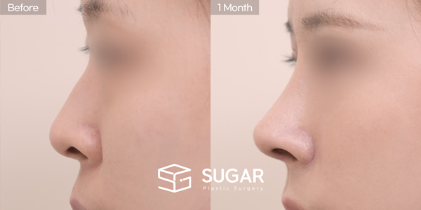 SUGAR美容外科 初) 鼻筋プロテーゼ + 寄贈肋軟骨 + 鼻中隔軟骨 + 鷲鼻矯正 + 鼻孔下げ + 小鼻縮小 症例写真 - 側面の施術前後比較