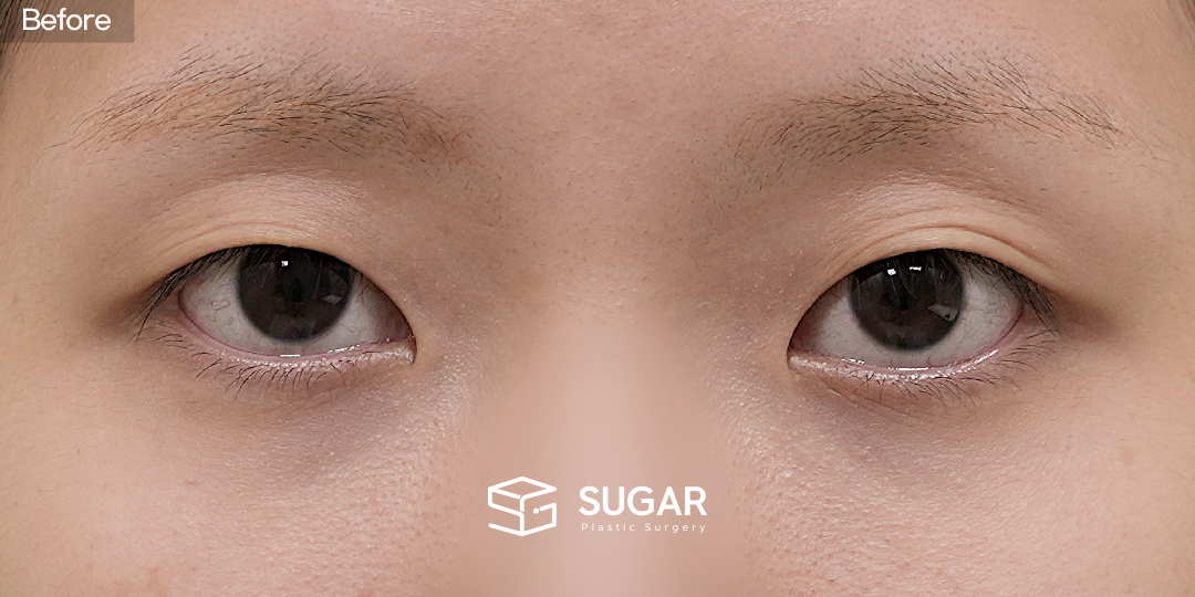 SUGAR美容外科 初) 非切開眼瞼下垂矯正 + 目頭切開 症例写真 - 施術前