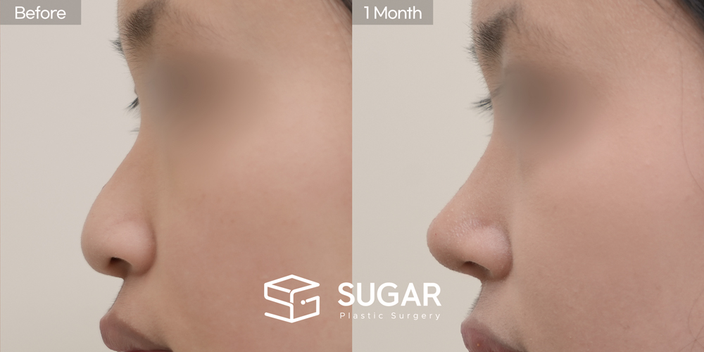 SUGAR美容外科 初) 鼻背(隆鼻) + 耳後筋膜 + 鼻尖形成 + 鼻中隔 + 耳介軟骨移植 + 団子鼻修正 + 長鼻短縮 症例写真 - 側面の施術前後比較