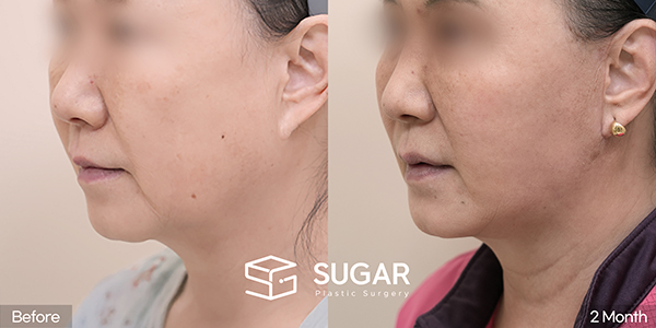 SUGAR美容外科 初) フェイスリフト + 自然癒着 + 下眼瞼形成術 + 眉毛挙上 症例写真 - 側面の施術前後比較
