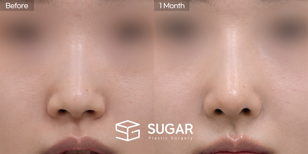 SUGAR美容外科 初) 同種肋軟骨 + 耳介軟骨移植 + 鼻背（隆鼻） + 骨切り + 団子鼻修正 症例写真 - 正面の施術前後比較