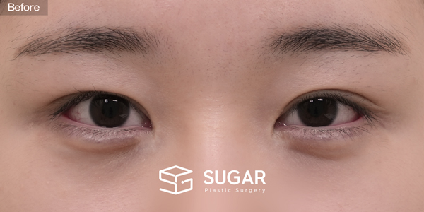 SUGAR美容外科 再) 自然癒着 + 目つき矯正 + 目上切開 + 目尻切開＋タレ目形成 症例写真 - 施術前