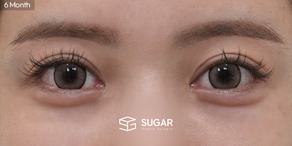 SUGAR美容外科 再) 切開 症例写真 - 施術後