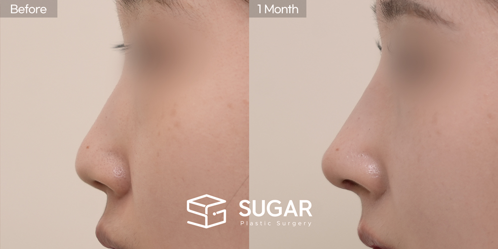 SUGAR美容外科 初) 鼻筋プロテーゼ + 鼻先(寄贈肋軟骨＋耳介軟骨) + 骨切り幅寄せ + 団子鼻矯正 症例写真 - 側面の施術前後比較