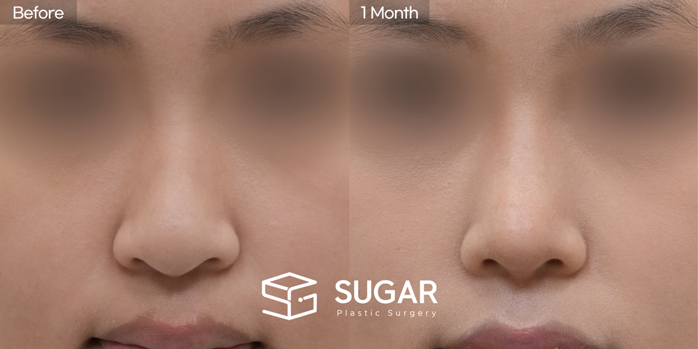 SUGAR美容外科 初) 鼻背（隆鼻） + 耳後筋膜 + 鼻尖形成 + 鼻中隔 + 耳介軟骨移植 + 団子鼻修正 + 長鼻短縮 症例写真 - 正面の施術前後比較