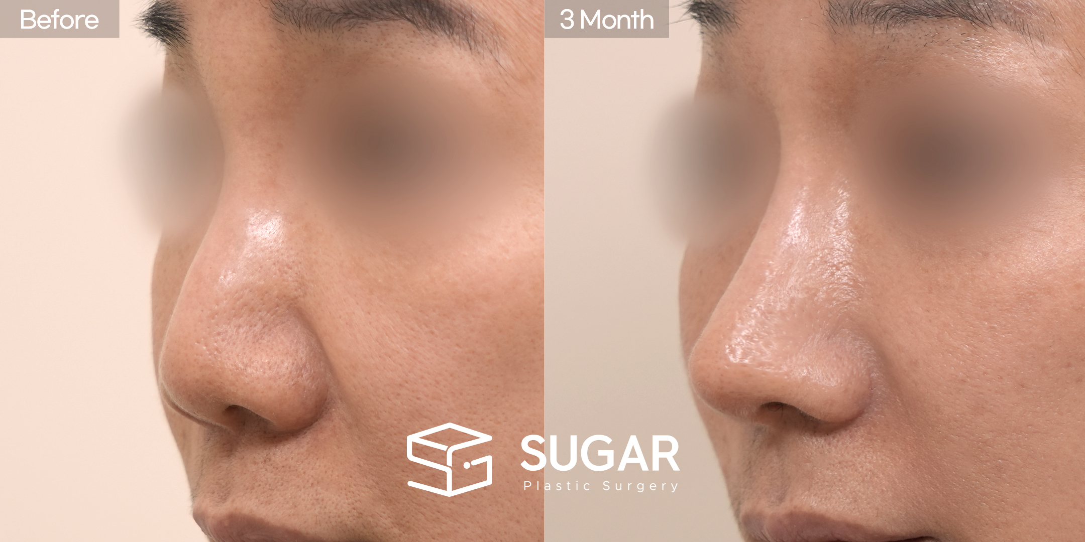 SUGAR美容外科 再) 異物除去+鼻筋プロテーゼ交換+骨切り幅寄せ+鼻尖形成（寄贈肋軟骨+耳介軟骨 使用）+鼻中隔延長 + 団子鼻矯正 + 小鼻縮小 症例写真 - 45度の施術前後比較