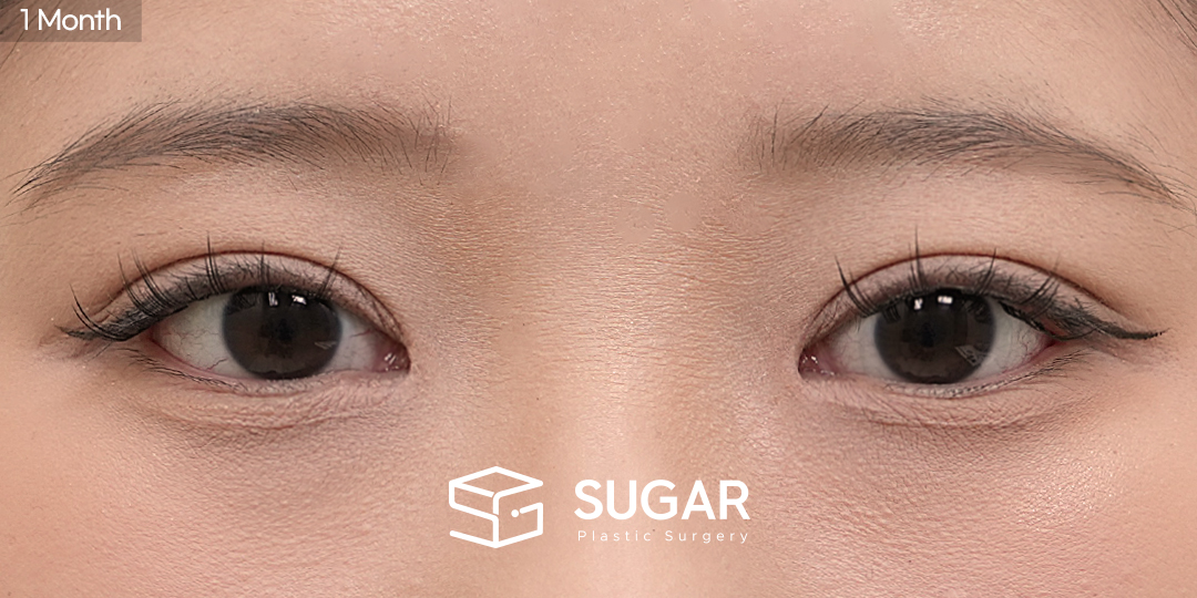 SUGAR美容外科 初) 埋没法 + 目つき矯正 + 目頭切開 症例写真 - 施術後