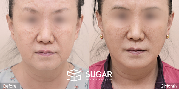 SUGAR美容外科 初) フェイスリフト + 自然癒着 + 下眼瞼形成術 + 眉毛挙上 症例写真 - 正面の施術前後比較