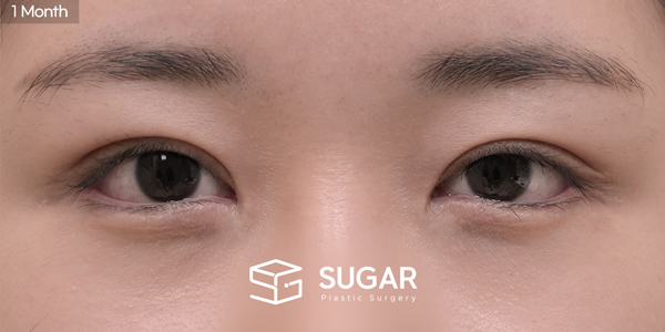 SUGAR美容外科 再) 自然癒着 + 目つき矯正 + 目上切開 + 目尻切開＋タレ目形成 症例写真 - 施術後