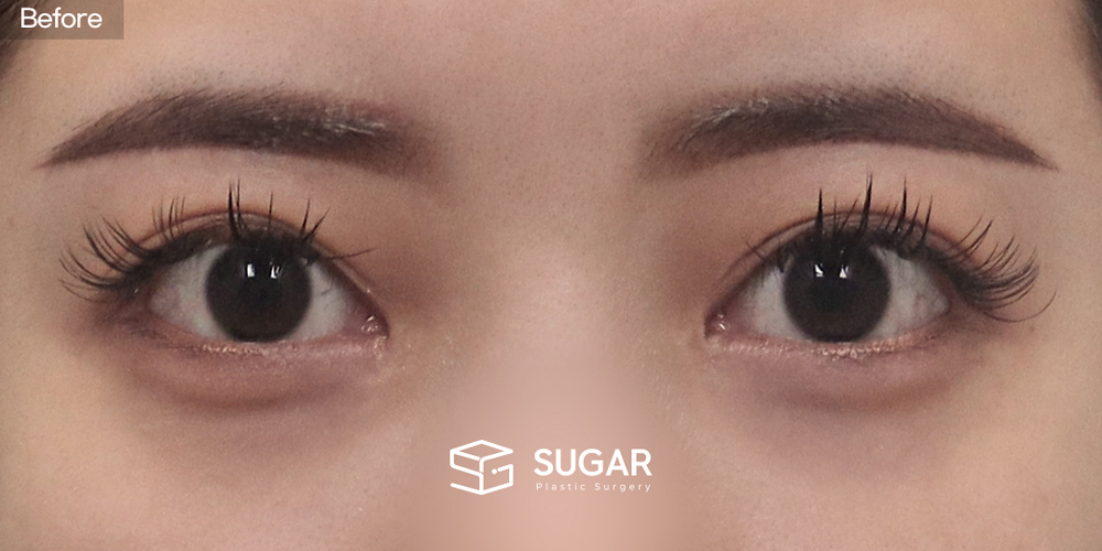 SUGAR美容外科 再) 切開 症例写真 - 施術前
