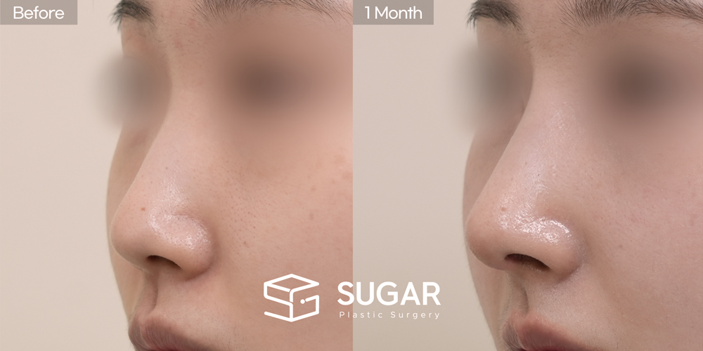 SUGAR美容外科 初) 鼻筋プロテーゼ + 鼻先(寄贈肋軟骨＋耳介軟骨) + 骨切り幅寄せ + 団子鼻矯正 症例写真 - 45度の施術前後比較
