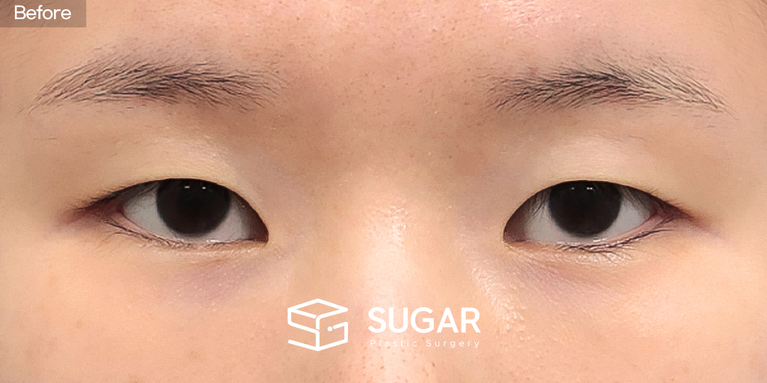 SUGAR美容外科 初) 自然癒着 + 目つき矯正 + 目頭切開 症例写真 - 施術前