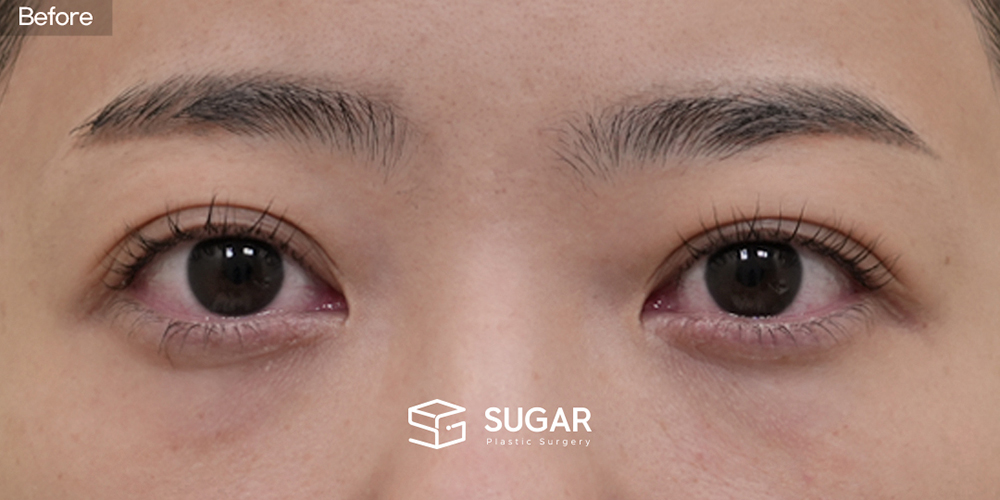 SUGAR美容外科 初) 下眼瞼脂肪再配置 + 前額リフト + プロテーゼなし隆鼻 + 自家肋軟骨 + 小鼻縮小 + 団子鼻修正 + 鼻柱延長 症例写真 - 施術前