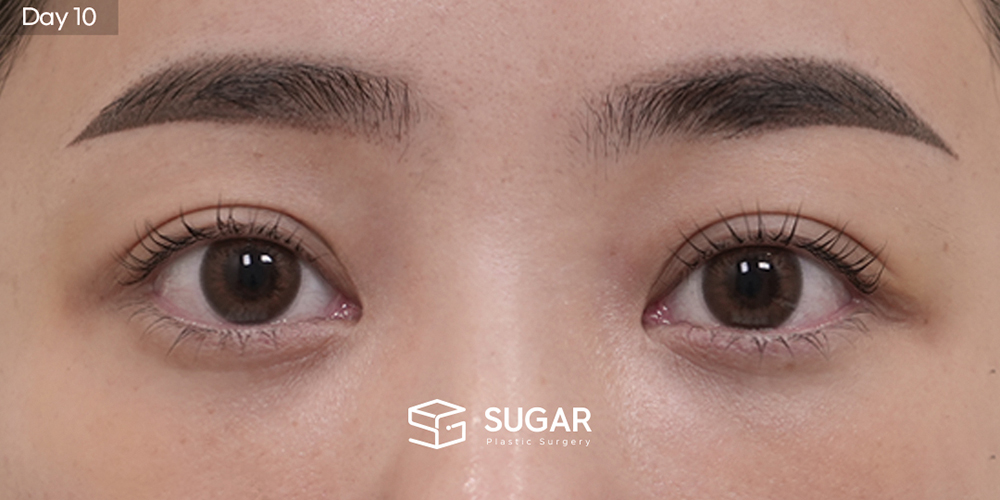 SUGAR美容外科 初) 下眼瞼脂肪再配置 + 前額リフト + プロテーゼなし隆鼻 + 自家肋軟骨 + 小鼻縮小 + 団子鼻修正 + 鼻柱延長 症例写真 - 施術後