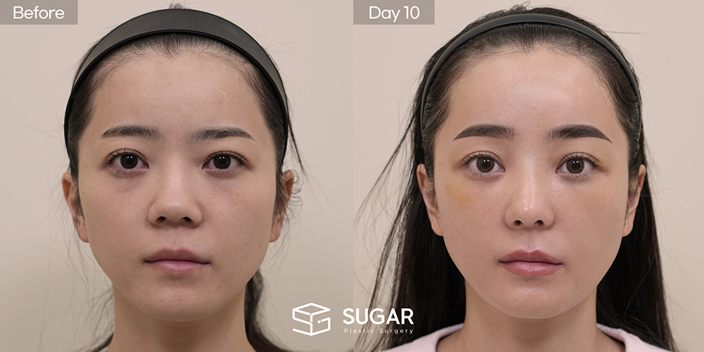SUGAR美容外科 初) 下眼瞼脂肪再配置 + 前額リフト + プロテーゼなし隆鼻 + 自家肋軟骨 + 小鼻縮小 + 団子鼻修正 + 鼻柱延長 症例写真 - 正面の施術前後比較