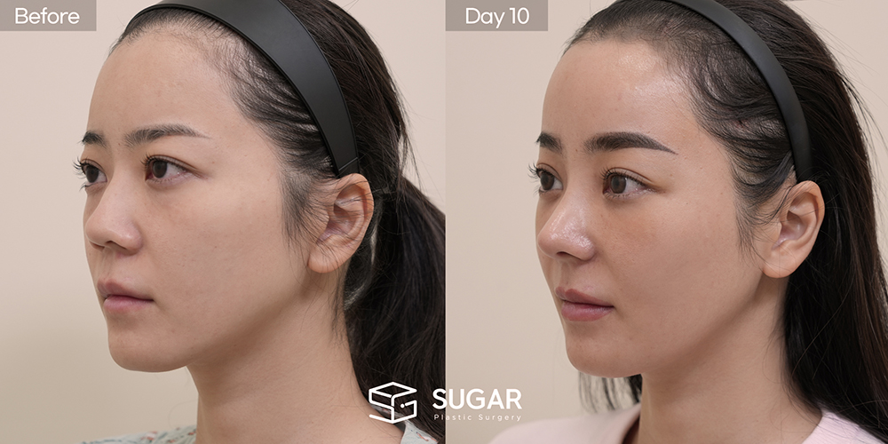 SUGAR美容外科 初) 下眼瞼脂肪再配置 + 前額リフト + プロテーゼなし隆鼻 + 自家肋軟骨 + 小鼻縮小 + 団子鼻修正 + 鼻柱延長 症例写真 - 45度の施術前後比較