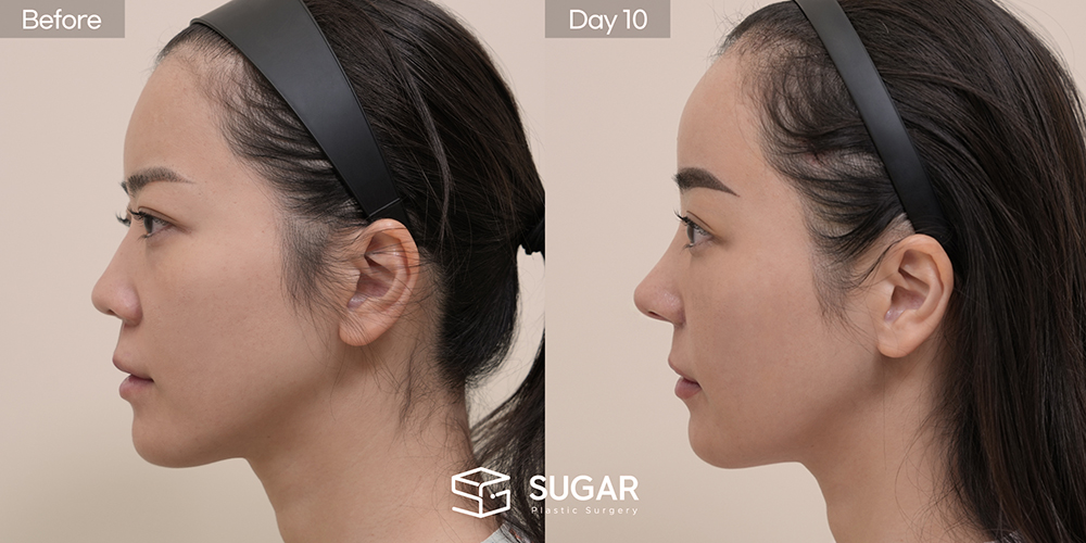 SUGAR美容外科 初) 下眼瞼脂肪再配置 + 前額リフト + プロテーゼなし隆鼻 + 自家肋軟骨 + 小鼻縮小 + 団子鼻修正 + 鼻柱延長 症例写真 - 側面の施術前後比較