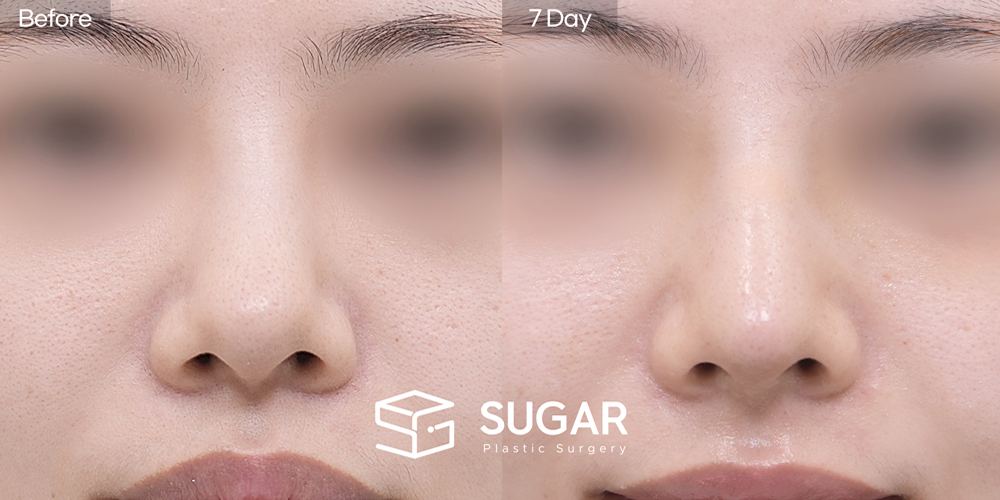 SUGAR美容外科 初) 鼻背（隆鼻） + 鼻尖形成 + 鼻中隔 + 耳介軟骨移植 + 同種肋軟骨 + 鼻柱延長 + 団子鼻修正 症例写真 - 正面の施術前後比較