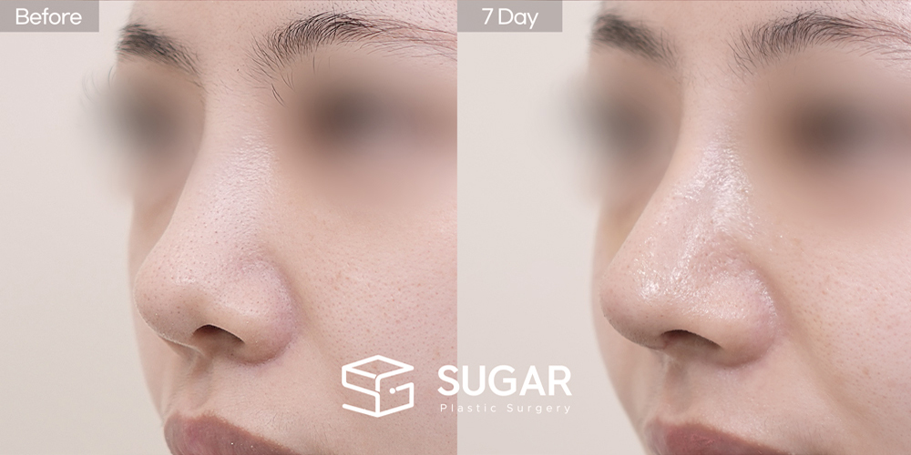 SUGAR美容外科 初) 鼻背（隆鼻） + 鼻尖形成 + 鼻中隔 + 耳介軟骨移植 + 同種肋軟骨 + 鼻柱延長 + 団子鼻修正 症例写真 - 45度の施術前後比較