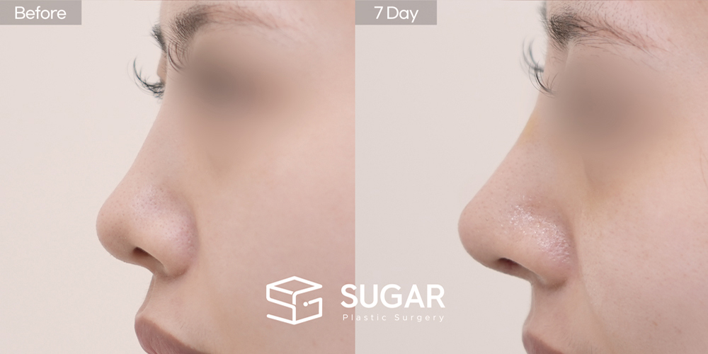 SUGAR美容外科 初) 鼻背（隆鼻） + 鼻尖形成 + 鼻中隔 + 耳介軟骨移植 + 同種肋軟骨 + 鼻柱延長 + 団子鼻修正 症例写真 - 側面の施術前後比較