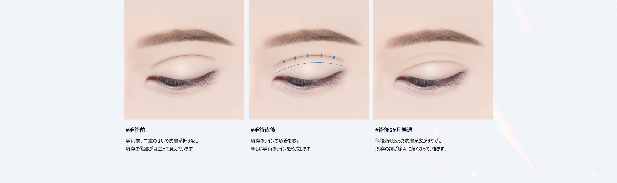 #手術前 : 手術前、二重のせいで皮膚が折り返し既存の傷跡が目立って見えています。/ #手術直後 : 既存のラインの癒着を取り新しい手術のラインを形成します。 / #術後6ヶ月経過 : 術後折り返った皮膚が広がりながら既存の跡が徐々に薄くなっていきます。