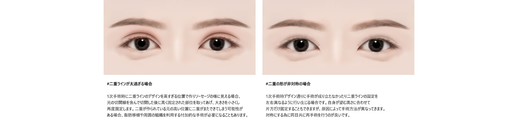 #二重ラインが太過ぎる場合 : 1次手術時に二重ラインのデザインを高すぎる位置で作りソーセージの様に見える場合、元の切開線を含んで切開した後に高く固定された部位を取ってあげ、大きさを小さくし再度固定します。二重が作られている元の高い位置に二重がまたできてしまう可能性がある場合、脂肪移植や周囲の組織を利用する付加的な手術が必要になることもあります。 / #二重の形が非対称の場合 : 1次手術時デザイン通りに手術が成り立たなかったり二重ラインの固定を左右異なるように行い生じる場合です。自身が望む高さに合わせて片方だけ固定することもできますが、原因によって手術方法が異なってきます。対称にする為に両目共に再手術を行うのが良いです。