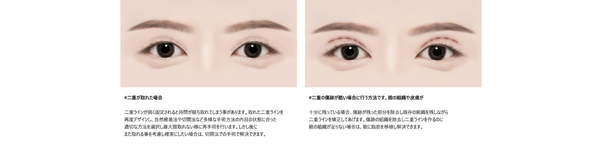 #二重が取れた場合 : 二重ラインが弱く固定されると時間が経ち取れてしまう事があります。取れた二重ラインを再度デザインし、自然癒着法や切開法など多様な手術方法の内目の状態に合った適切な方法を選択し最大限取れない様に再手術を行います。しかし後にまた取れる事を考慮し確実にしたい場合は、切開法での手術で解決できます。/ #二重の傷跡が酷い場合に行う方法です。瞼の組織や皮膚が : 十分に残っている場合、傷跡が残った部分を除去し既存の組織を残しながら二重ラインを矯正してあげます。傷跡の組織を除去し二重ラインを作るのに瞼の組織が足りない場合は、瞼に脂肪を移植し解決できます。