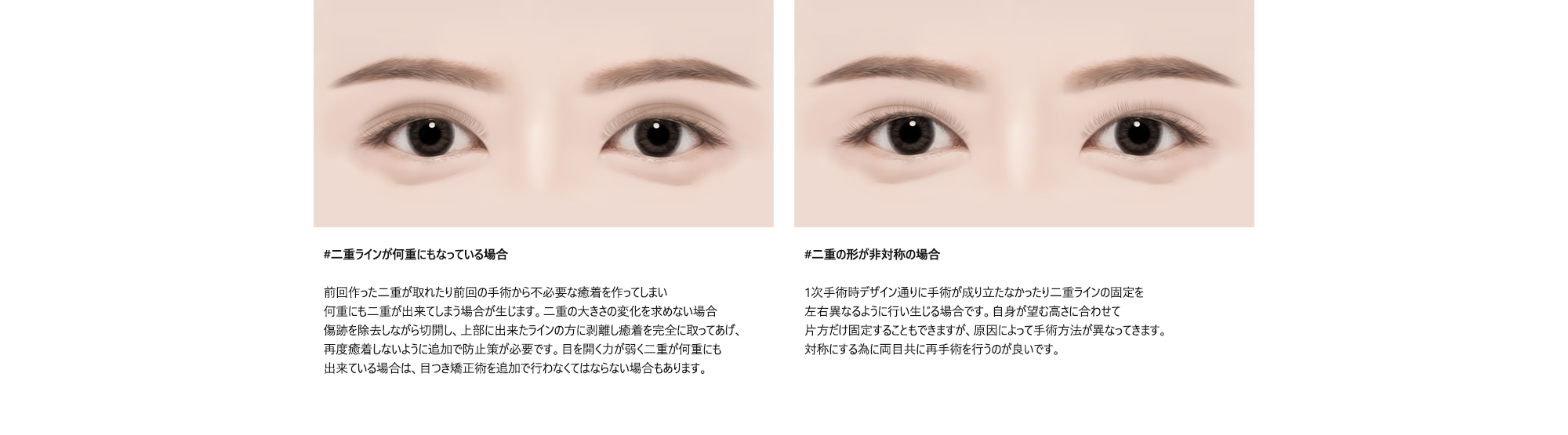 #二重ラインが何重にもなっている場合 : 前回作った二重が取れたり前回の手術から不必要な癒着を作ってしまい何重にも二重が出来てしまう場合が生じます。二重の大きさの変化を求めない場合傷跡を除去しながら切開し、上部に出来たラインの方に剥離し癒着を完全に取ってあげ、再度癒着しないように追加で防止策が必要です。目を開く力が弱く二重が何重にも出来ている場合は、目つき矯正術を追加で行わなくてはならない場合もあります。/ #二重の形が非対称の場合 : 1次手術時デザイン通りに手術が成り立たなかったり二重ラインの固定を左右異なるように行い生じる場合です。自身が望む高さに合わせて片方だけ固定することもできますが、原因によって手術方法が異なってきます。対称にする為に両目共に再手術を行うのが良いです。