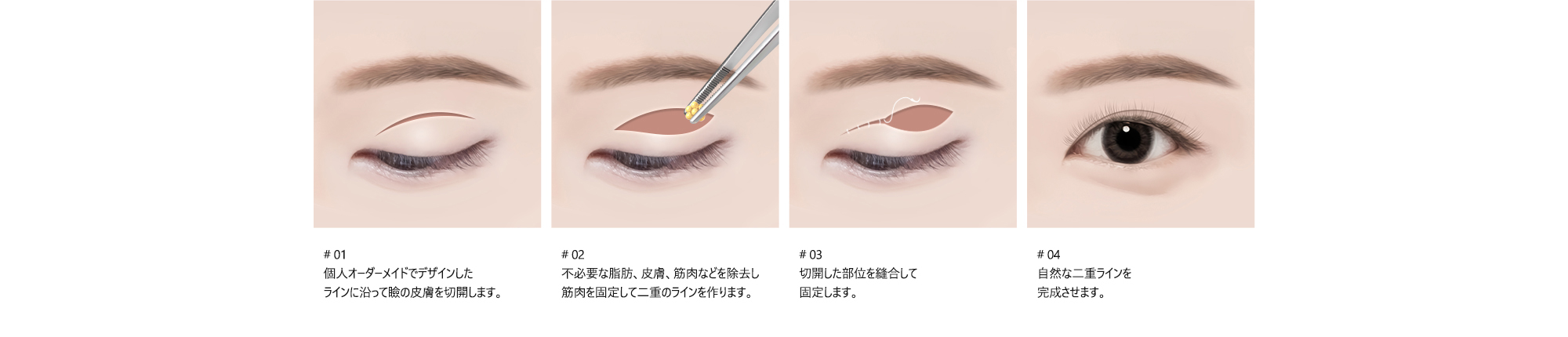 # 01 : 個人オーダーメイドでデザインした ラインに沿って瞼の皮膚を切開します。 / # 02 : 不必要な脂肪、皮膚、筋肉などを除去し 筋肉を固定して二重のラインを作ります。 / # 03 : 切開した部位を縫合して 固定します。 / # 04 : 自然な二重ラインを 完成させます。