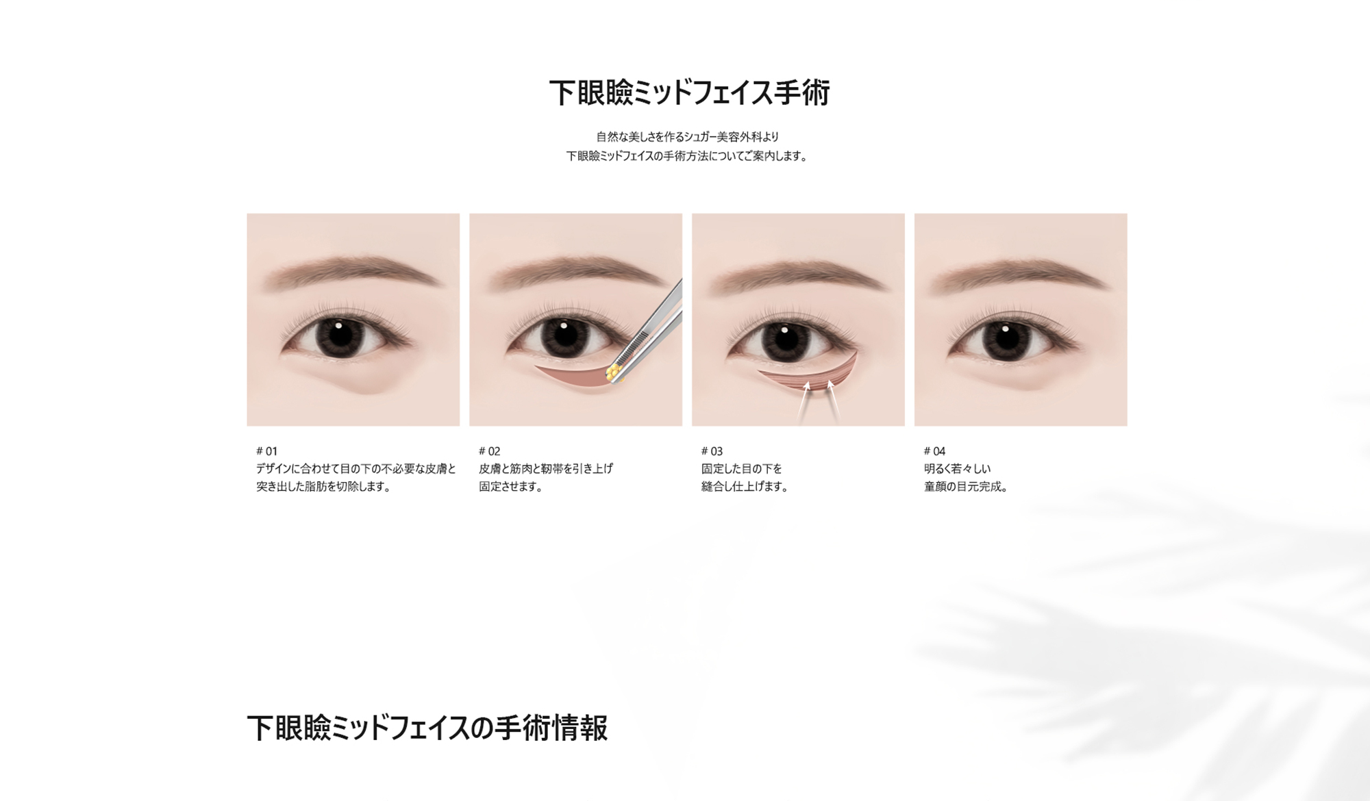 [下眼瞼ミッドフェイス手術] # 01 : デザインに合わせて目の下の不必要な皮膚と突き出した脂肪を切除します。 / # 02 : 皮膚と筋肉と靭帯を引き上げ固定させます。 / # 03 : 固定した目の下を縫合し仕上げます。 / # 04 : 明るく若々しい童顔の目元完成。