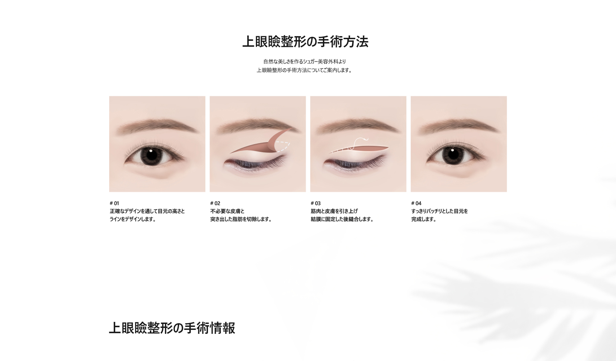 [上眼瞼整形の手術方法] # 01 : 正確なデザインを通して目元の高さとラインをデザインします。 / # 02 : 不必要な皮膚と突き出した脂肪を切除します。 / # 03 : 筋肉と皮膚を引き上げ結膜に固定した後縫合します。 / # 04 : すっきりパッチリとした目元を完成します。 