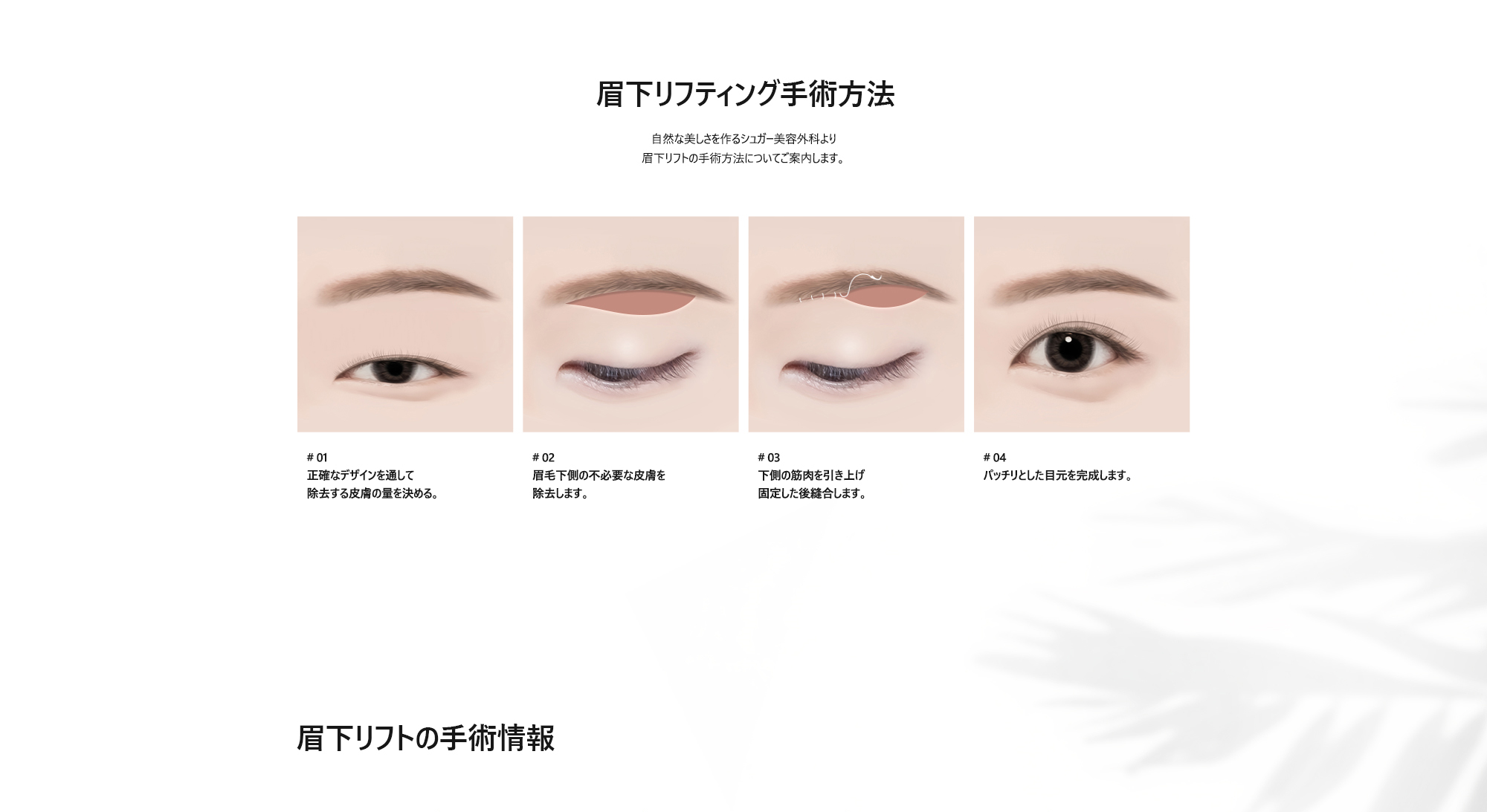 [眉下リフティング手術方法] # 01 : 正確なデザインを通して除去する皮膚の量を決める。 / # 02 : 眉毛下側の不必要な皮膚を除去します。 / # 03 : 下側の筋肉を引き上げ固定した後縫合します。 / # 04 : パッチリとした目元を完成します。 