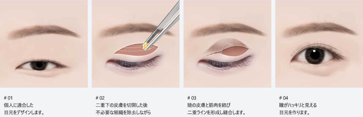 # 01 : 個人に適合した 目元をデザインします。/ # 02 : 二重下の皮膚を切開した後 不必要な組織を除去しながら 目を開く筋肉の長さを短縮してあげます。/ # 03 : 瞼の皮膚と筋肉を結び 二重ラインを形成し縫合します。/ # 04 : 瞳がハッキリと見える 目元を作ります。