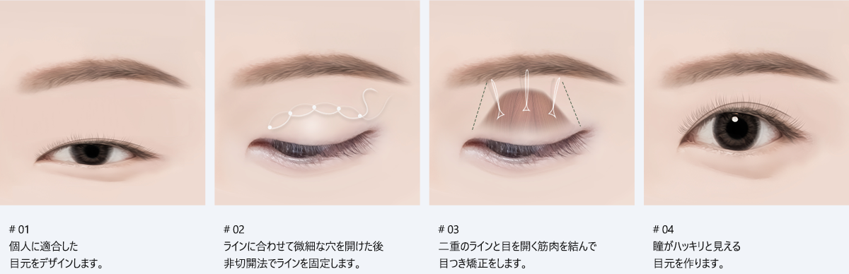 # 01 : 個人に適合した目元をデザインします。/ # 02 : ラインに合わせて微細な穴を開けた後非切開法でラインを固定します。/ # 03 : 二重のラインと目を開く筋肉を結んで目つき矯正をします。/ # 04 : 瞳がハッキリと見える目元を作ります。