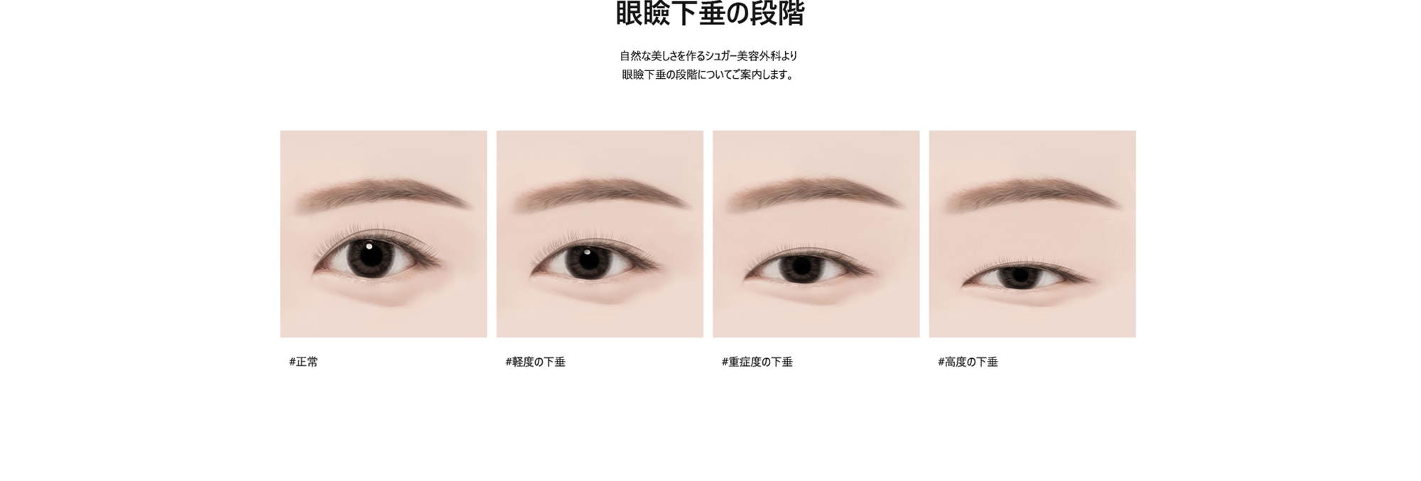 [眼瞼下垂の段階] 自然な美しさを作るシュガー美容外科より眼瞼下垂の段階についてご案内します。