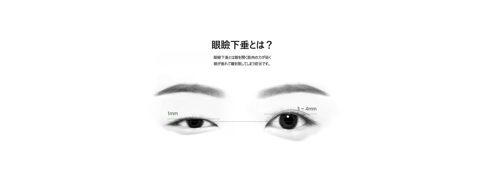 [眼瞼下垂とは？] 眼瞼下垂とは瞼を開く筋肉の力が弱く瞼が垂れて瞳を隠してしまう症状です。