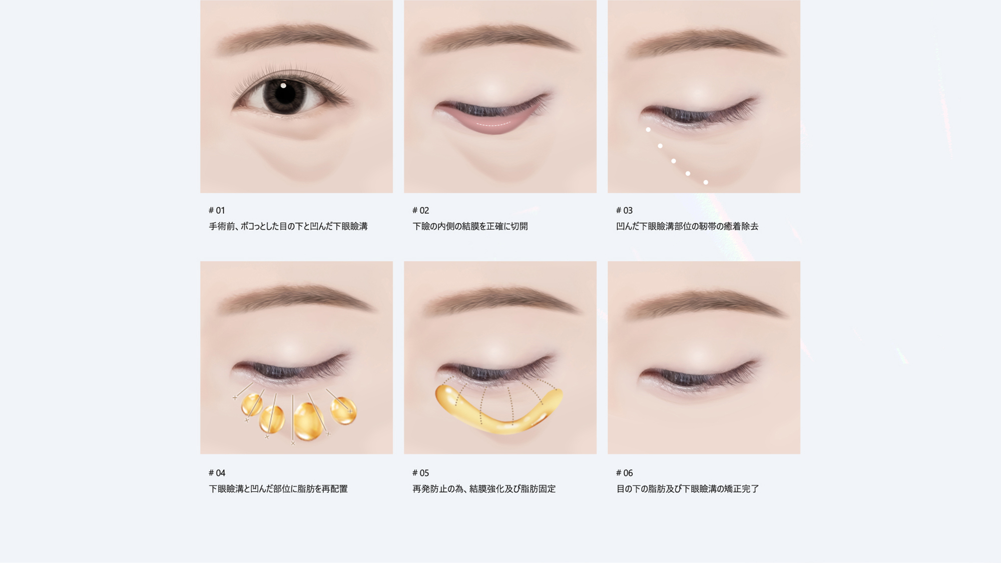 # 01 : 手術前、ボコっとした目の下と凹んだ下眼瞼溝 / # 02 : 下瞼の内側の結膜を正確に切開 / # 03 : 凹んだ下眼瞼溝部位の靭帯の癒着除去 / # 04 : 下眼瞼溝と凹んだ部位に脂肪を再配置 / # 05 : 再発防止の為、結膜強化及び脂肪固定 / # 06 : 目の下の脂肪及び下眼瞼溝の矯正完了