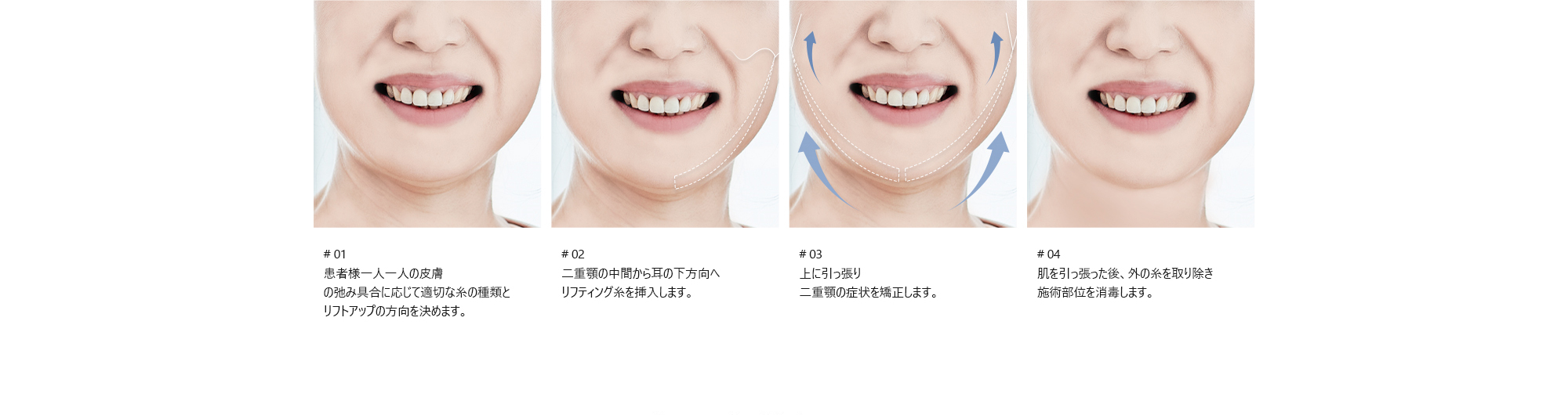 # 01 : 患者様一人一人の皮膚の弛み具合に応じて適切な糸の種類とリフトアップの方向を決めます。/ # 02 : 二重顎の中間から耳の下方向へリフティング糸を挿入します。/ # 03 : 上に引っ張り二重顎の症状を矯正します。/ # 04 : 肌を引っ張った後、外の糸を取り除き施術部位を消毒します。