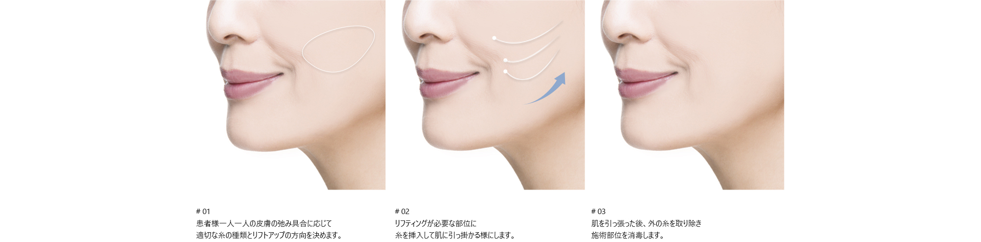 # 01 : 患者様一人一人の皮膚の弛み具合に応じて適切な糸の種類とリフトアップの方向を決めます。/ # 02 : リフティングが必要な部位に糸を挿入して肌に引っ掛かる様にします。/ # 03 : 肌を引っ張った後、外の糸を取り除き施術部位を消毒します。