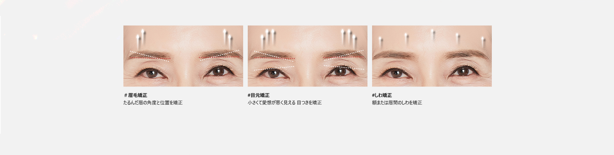 ＃眉毛矯正 : たるんだ眉の角度と位置を矯正 / #目元矯正 : 小さくて愛想が悪く見える 目つきを矯正 / #しわ矯正 : 額または眉間のしわを矯正