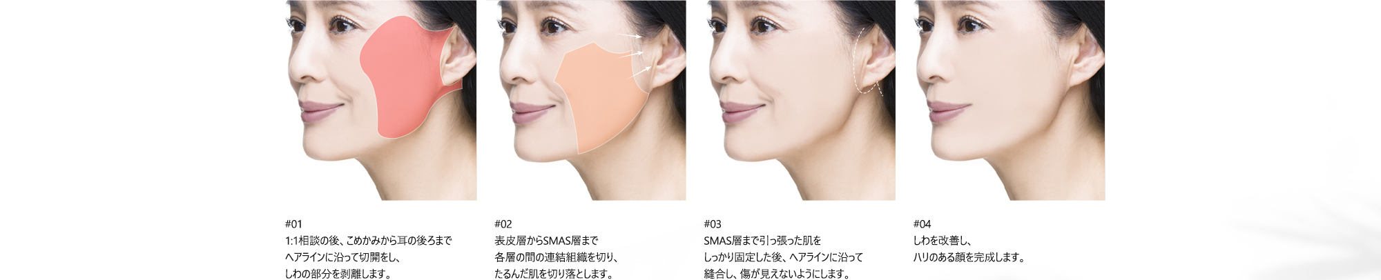 #01 : 1:1相談の後、こめかみから耳の後ろまでヘアラインに沿って切開をし、しわの部分を剥離します。 / #02 : 表皮層からSMAS層まで各層の間の連結組織を切り、たるんだ肌を切り落とします。 / #03 : SMAS層まで引っ張った肌をしっかり固定した後、ヘアラインに沿って縫合し、傷が見えないようにします。/ #04 : しわを改善し、ハリのある顔を完成します。