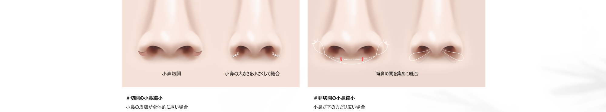 ＃切開の小鼻縮小 : 小鼻の皮膚が全体的に厚い場合 / ＃非切開の小鼻縮小 : 小鼻が下の方だけ広い場合