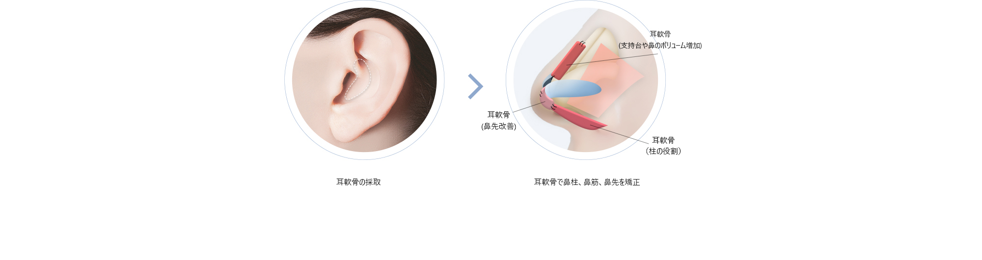 耳軟骨の採取 > 耳軟骨で鼻柱、鼻筋、鼻先を矯正
